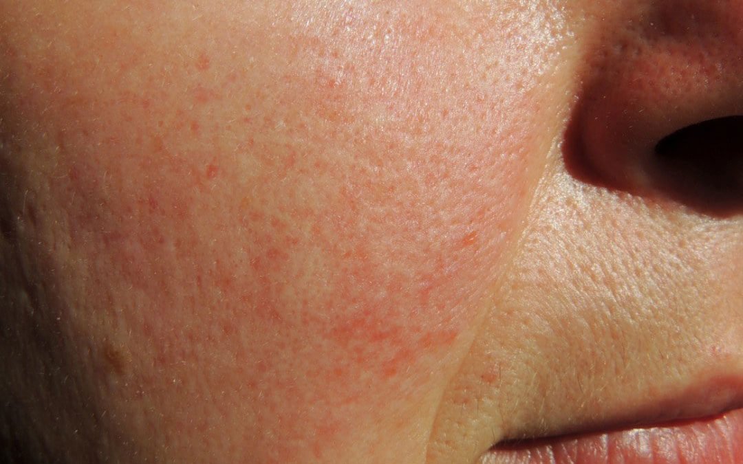 Couperose: cos’è. cause, sintomi, rimedi e prevenzione