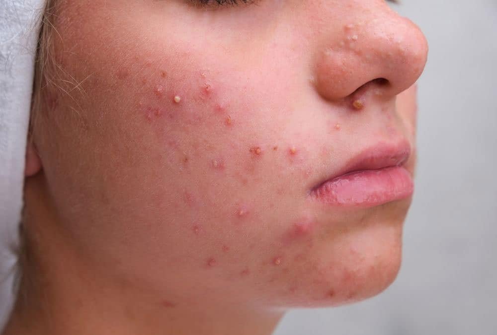 Acne cos'è sintomi cause rimedi convenzionali rimedi naturali fitoterapia fiori di bach oli essenziali massaggio DIABASI® Scuola Professionale di Massaggio Duilio La TEgola
