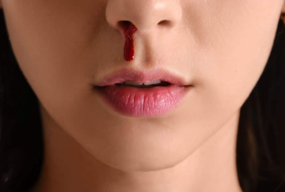 Sangue dal naso: cos’è, cause, terapie e consigli utili
