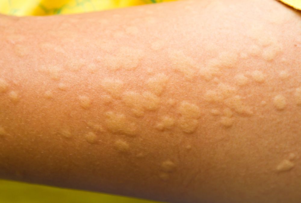 Orticaria: cos’è, cause e sintomi