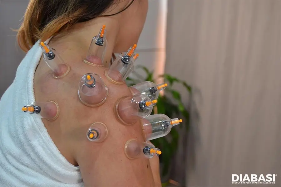 coppette applicate sulla schiena durante trattamento di coppettazione. diabasi scuola professionale di massaggio
